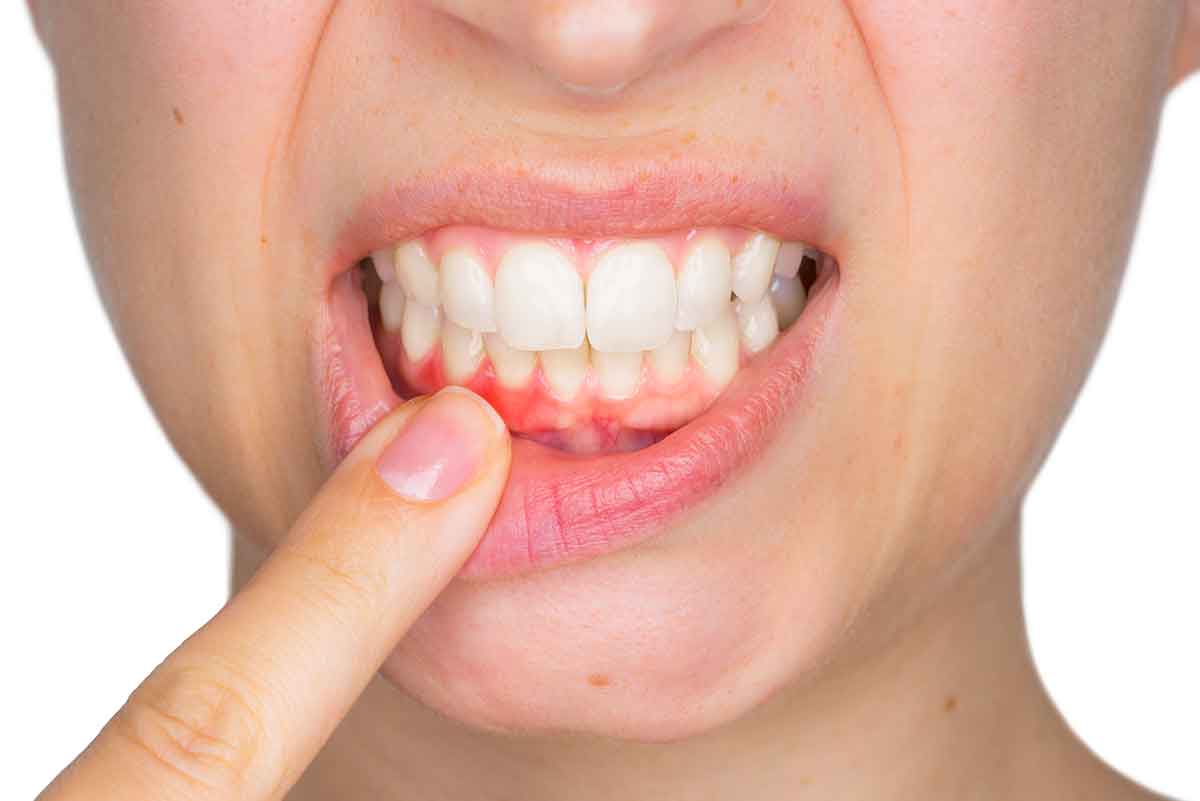Tụt lợi chân răng là gì?